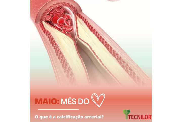 Calcificação arterial